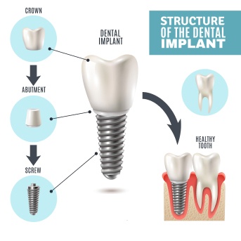 denta implants